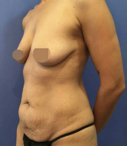 Tummy Tuck Before and After Pictures Washington, DC