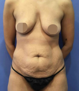 Tummy Tuck Before and After Pictures Washington, DC