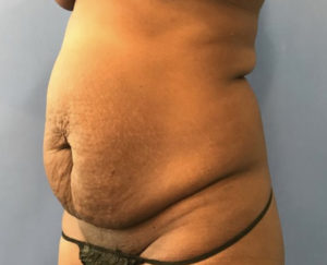 Tummy Tuck Before and After Pictures Washington, DC