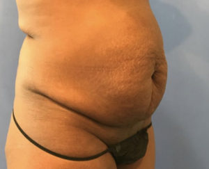 Tummy Tuck Before and After Pictures Washington, DC