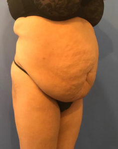 Tummy Tuck Before and After Pictures Washington, DC