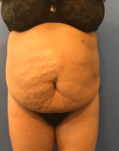 Tummy Tuck Before and After Pictures Washington, DC