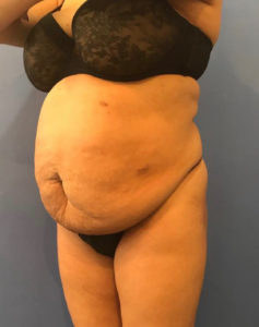 Tummy Tuck Before and After Pictures Washington, DC