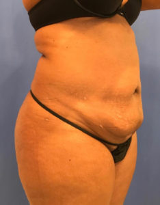 Tummy Tuck Before and After Pictures Washington, DC