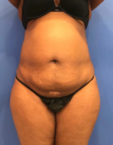 Tummy Tuck Before and After Pictures Washington, DC