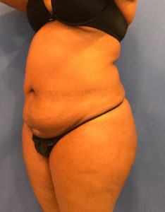 Tummy Tuck Before and After Pictures Washington, DC