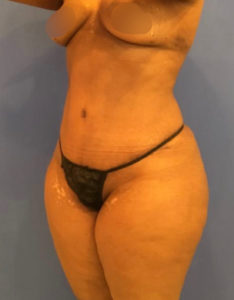 Tummy Tuck Before and After Pictures Washington, DC