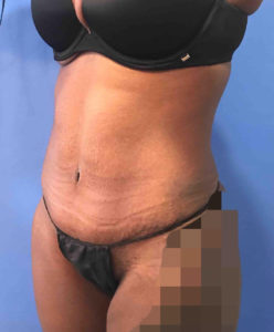 Tummy Tuck Before and After Pictures Washington, DC