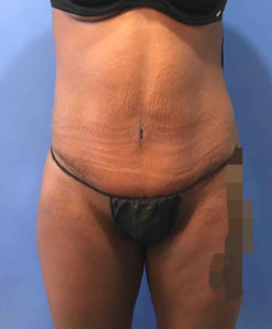 Tummy Tuck Before and After Pictures Washington, DC