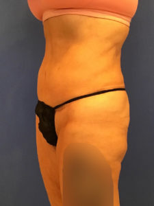 Tummy Tuck Before and After Pictures Washington, DC