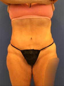 Tummy Tuck Before and After Pictures Washington, DC