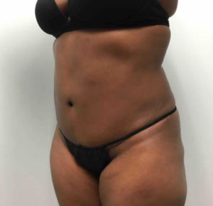 Tummy Tuck Before and After Pictures Washington, DC