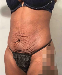 Tummy Tuck Before and After Pictures Washington, DC