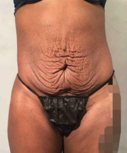 Tummy Tuck Before and After Pictures Washington, DC