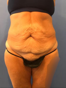 Tummy Tuck Before and After Pictures Washington, DC