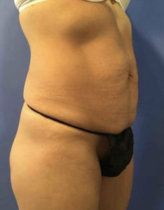 Tummy Tuck Before and After Pictures Washington, DC