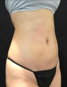 Liposuction Before and After Pictures Washington, DC