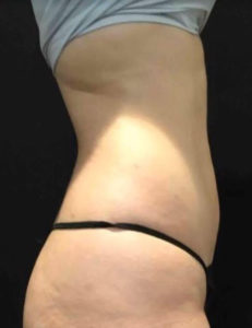 Liposuction Before and After Pictures Washington, DC