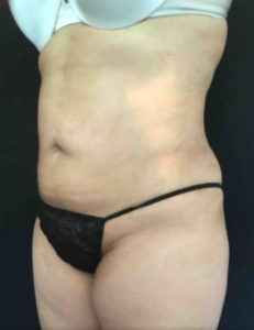 Liposuction Before and After Pictures Washington, DC