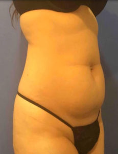 Liposuction Before and After Pictures Washington, DC