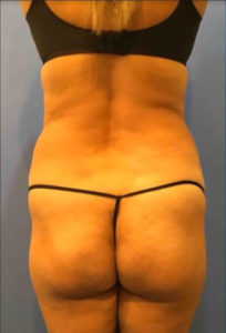 Liposuction Before and After Pictures Washington, DC