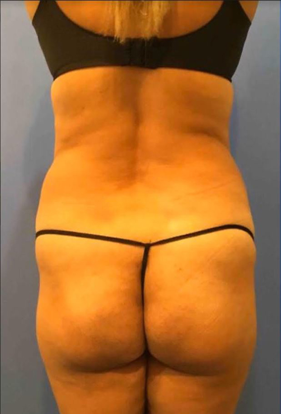 Liposuction Before and After Pictures Washington, DC