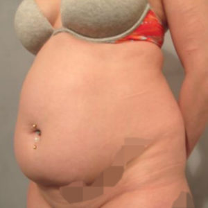 Liposuction Before and After Pictures Washington, DC