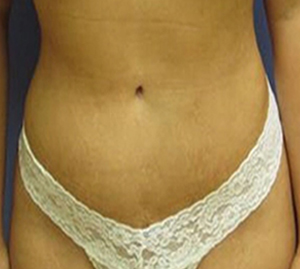 Tummy Tuck Before and After Pictures Washington, DC