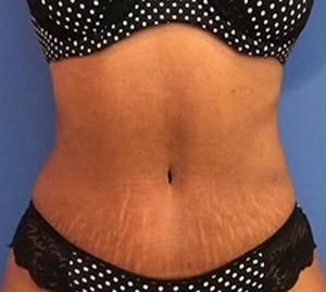 Tummy Tuck Before and After Pictures Washington, DC