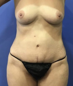 Tummy Tuck Before and After Pictures Washington, DC