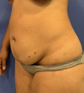 Tummy Tuck Before and After Pictures Washington, DC