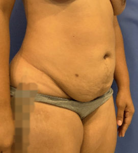 Tummy Tuck Before and After Pictures Washington, DC