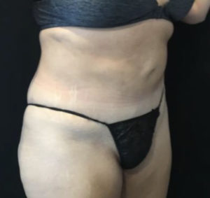 Tummy Tuck Before and After Pictures Washington, DC