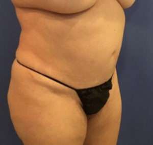 Tummy Tuck Before and After Pictures Washington, DC