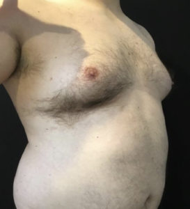 Liposuction Before and After Pictures Washington, DC