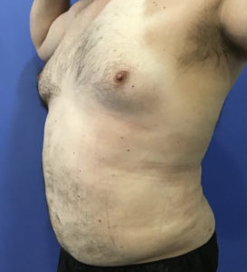 Liposuction Before and After Pictures Washington, DC