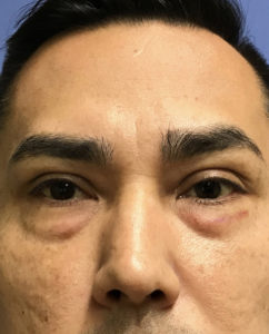 Eyelid Surgery Before and After Pictures Washington, DC