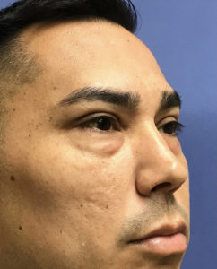 Eyelid Surgery Before and After Pictures Washington, DC