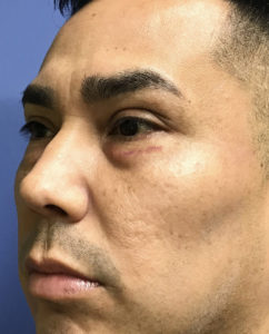 Eyelid Surgery Before and After Pictures Washington, DC