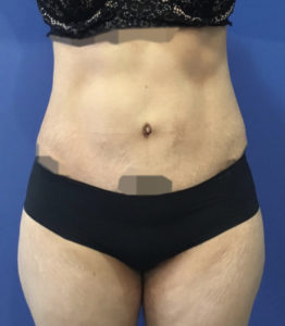 Tummy Tuck Before and After Pictures Washington, DC