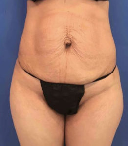 Tummy Tuck Before and After Pictures Washington, DC