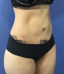 Tummy Tuck Before and After Pictures Washington, DC