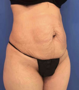 Tummy Tuck Before and After Pictures Washington, DC