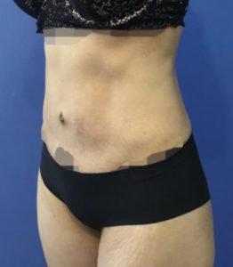 Tummy Tuck Before and After Pictures Washington, DC