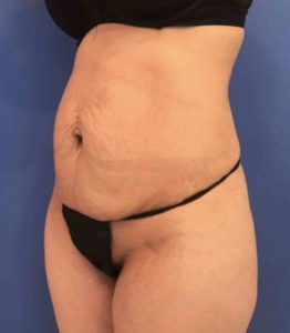 Tummy Tuck Before and After Pictures Washington, DC