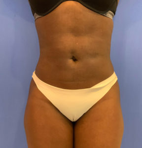 Liposuction Before and After Pictures Washington, DC