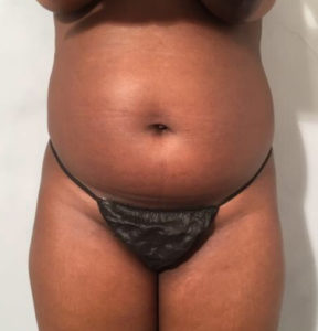 Liposuction Before and After Pictures Washington, DC