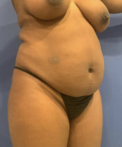 Tummy Tuck Before and After Pictures Washington, DC