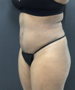 Tummy Tuck Before and After Pictures Washington, DC