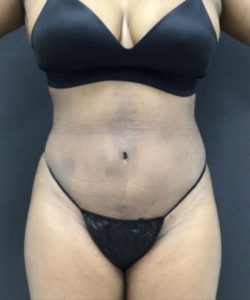 Tummy Tuck Before and After Pictures Washington, DC